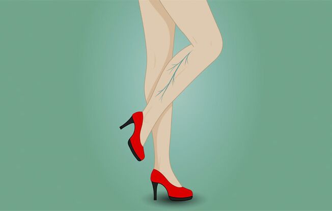 Varices on a woman's legs
