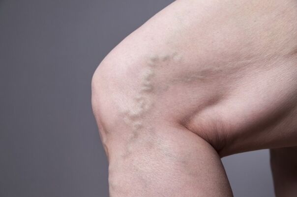 Varices in women