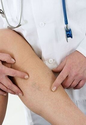 Lower limb varicose veins