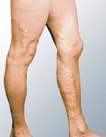 Varicose veins in a man's legs