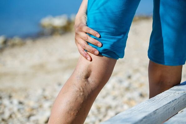 Shooting pain in the legs with varicose veins