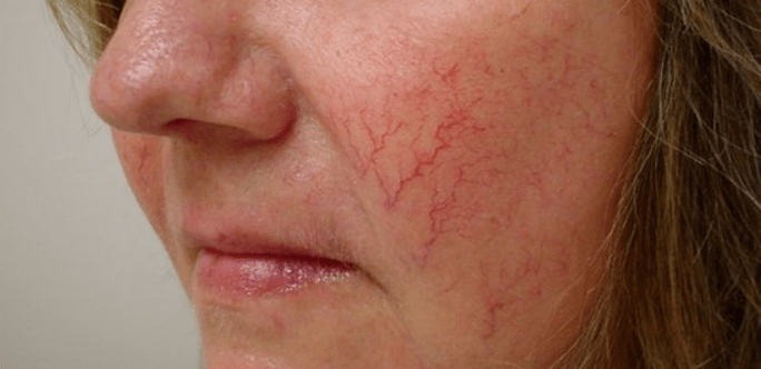 varicose veins on the face how to treat