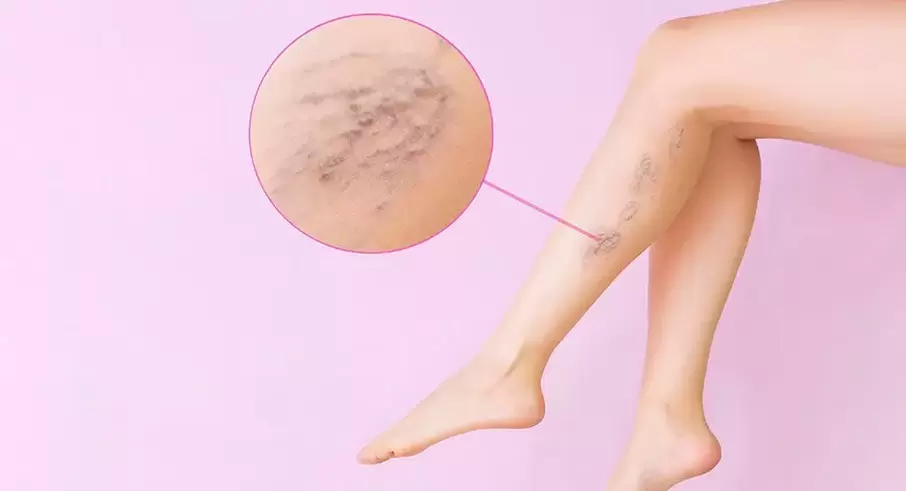 Protruding tortuous veins on the legs with varicose veins