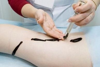 Leeches for varicose veins - an effective remedy for folk medicine