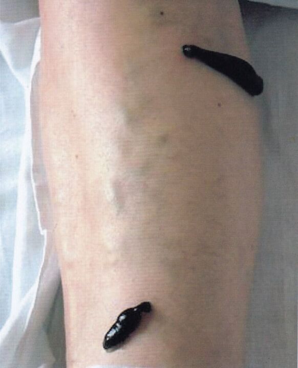 Hirudotherapy - treatment of varicose veins of the legs with leeches