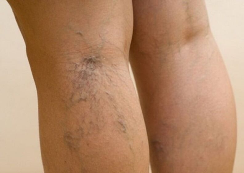 The beginning of the development of varicose veins in the legs